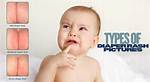 Do Diapers Cause Rashes?