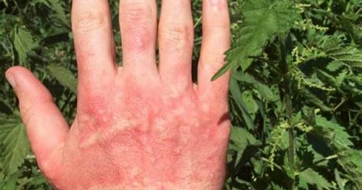 Do Dining Needles Sting?