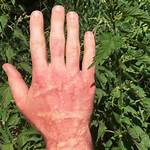 Do Dining Needles Sting?