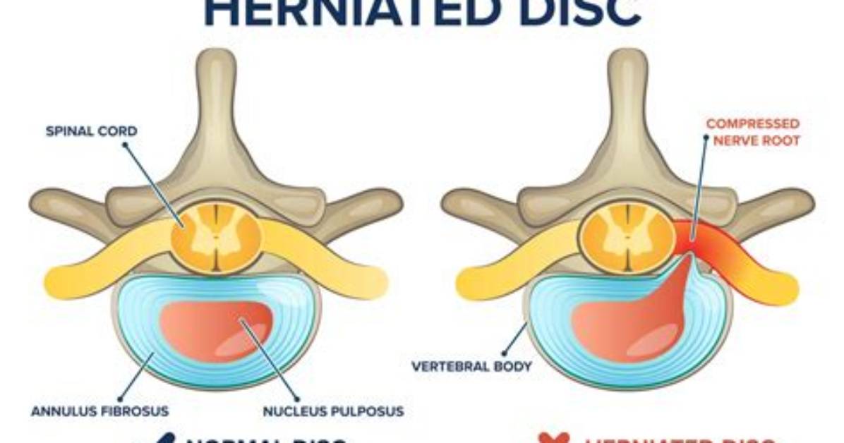 Do Disc Herniations Heal?