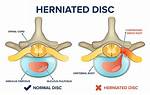 Do Disc Herniations Heal?