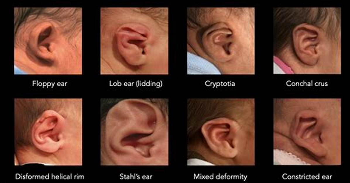 Do Ear Deformities Correct Themselves?