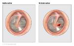 Do Eardrum Have Holes?
