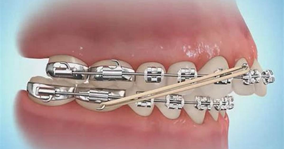 Do Elastics Actually Work?
