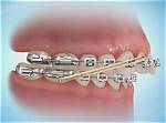 Do Elastics Actually Work?