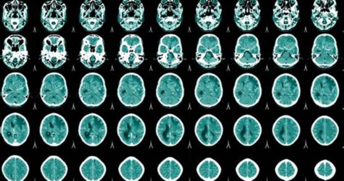 Do Encephalitis Go Away?