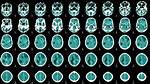 Do Encephalitis Go Away?
