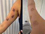 Do Etching Tattoos Last?