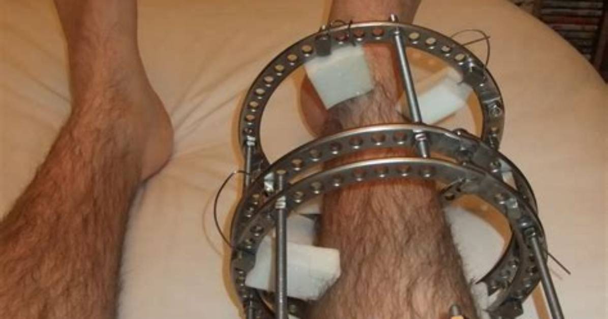 Do External Fixators Hurt