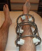 Do External Fixators Hurt