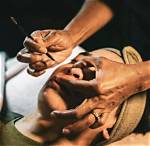 Do Extractions Cause Scarring?