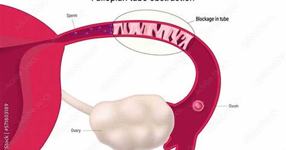 Do Fallopian Tubes Grow Back?