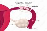 Do Fallopian Tubes Grow Back?