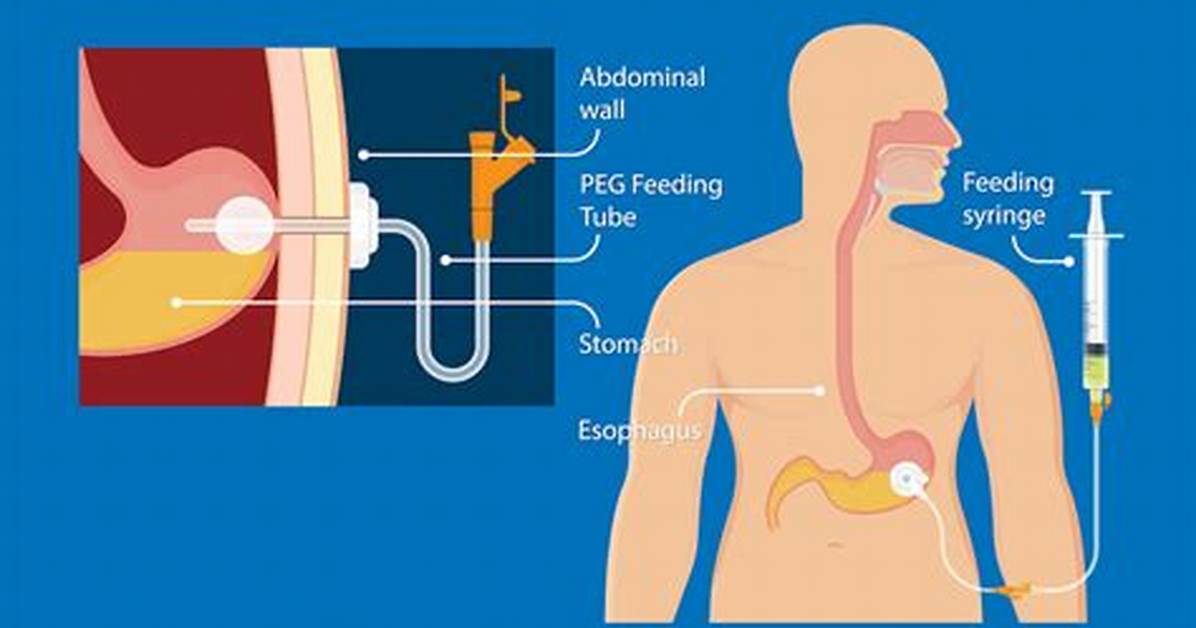 Do Feeding Tubes Work?