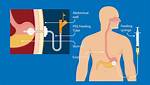 Do Feeding Tubes Work?