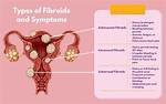 Do Fibroids Cause Bleeding?