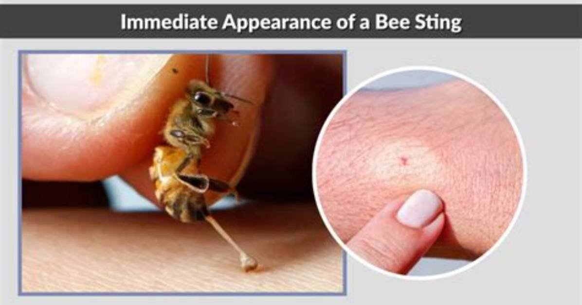 Do for a Bee Sting?