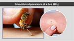 Do for a Bee Sting?