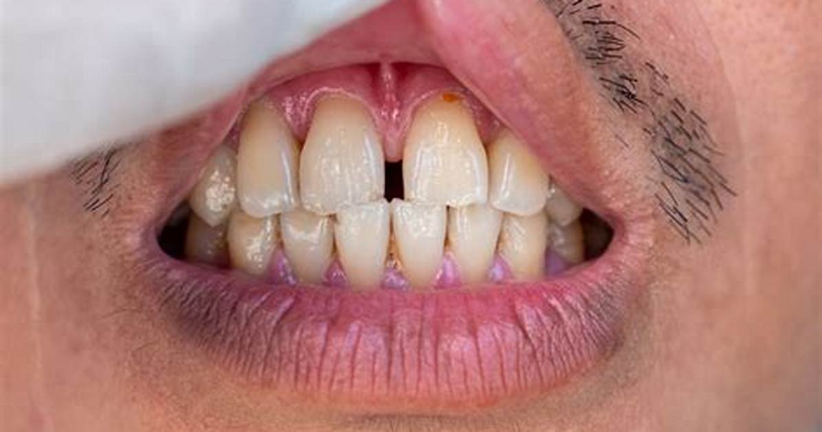 Do Gapped Teeth Close?