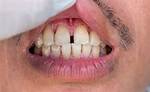 Do Gapped Teeth Close?