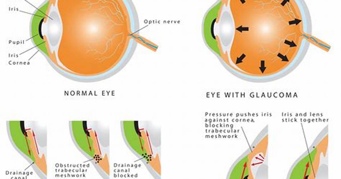 Do Glaucoma Suspects Always Develop Glaucoma?