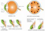 Do Glaucoma Suspects Always Develop Glaucoma?