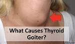 Do Goitres Get Bigger?