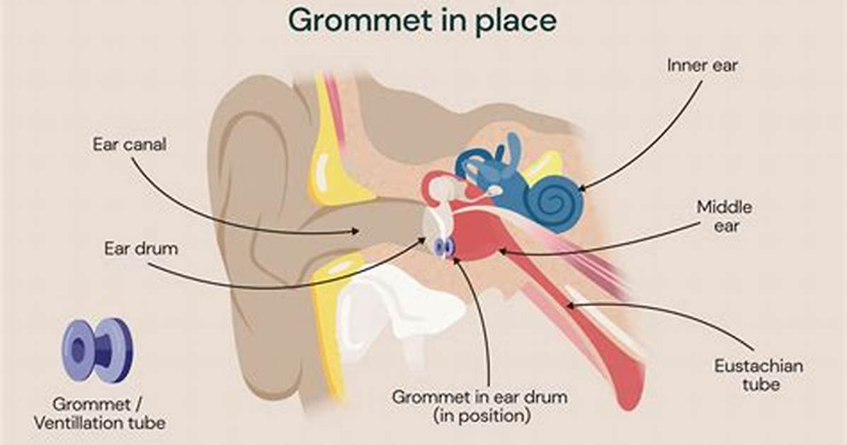 Do Grommets Affect Hearing?