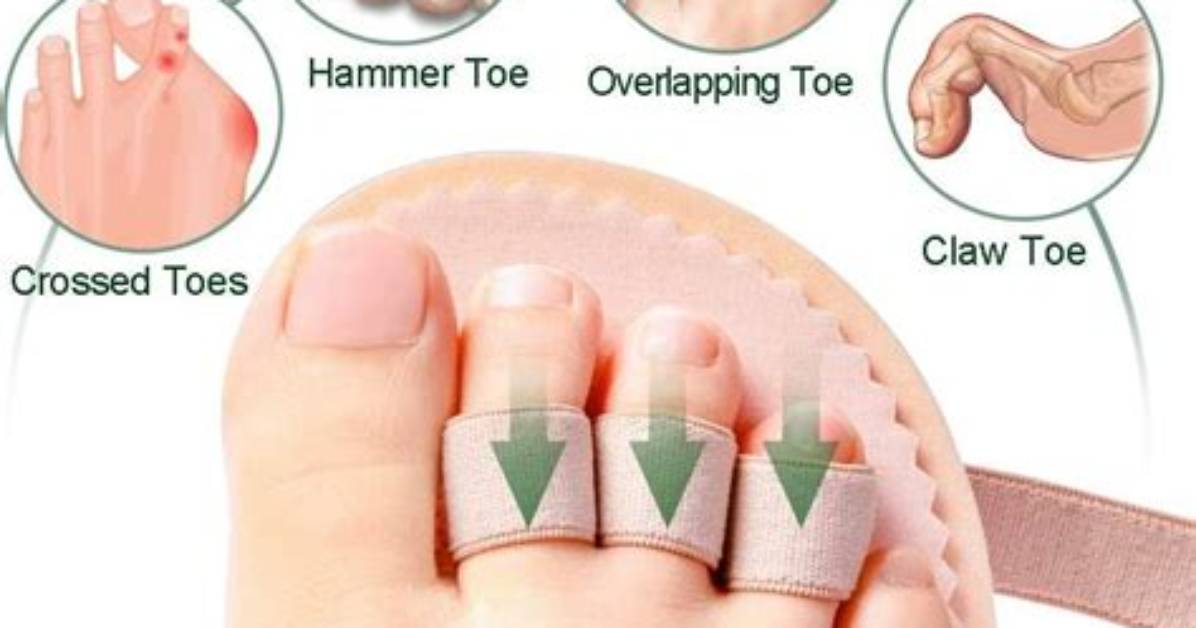 Do Hammer Toe Correctors Work?