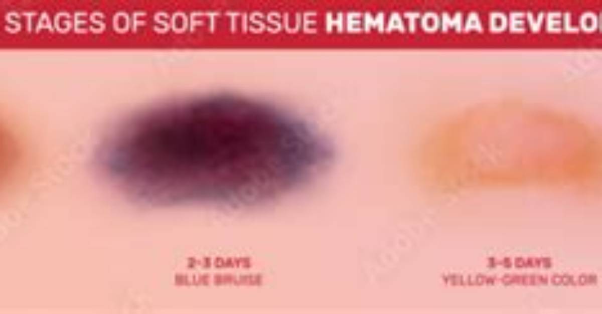 Do Hematomas Get Bigger?