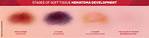 Do Hematomas Get Bigger?
