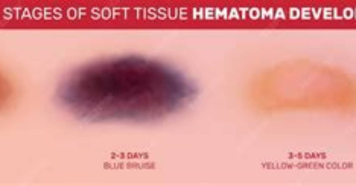 Do Hematomas Go Away?