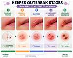 Do Herpes Recurrences Eventually Stop?