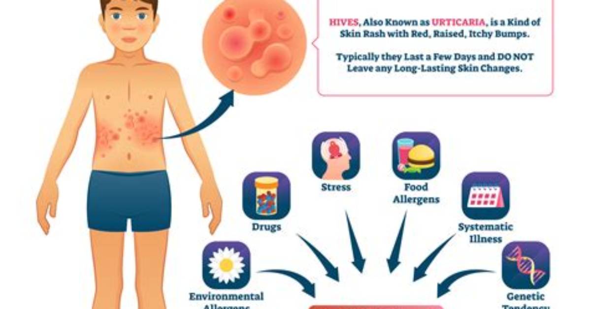Do Hives Spread When Itched?