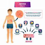 Do Hives Spread When Itched?
