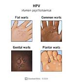 Do Hpv Warts Itch?