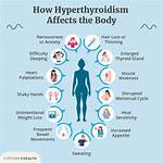 Do Hyperthyroid Medication Cause Weight Gain?