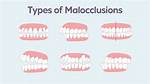 Do I Have Malocclusion?