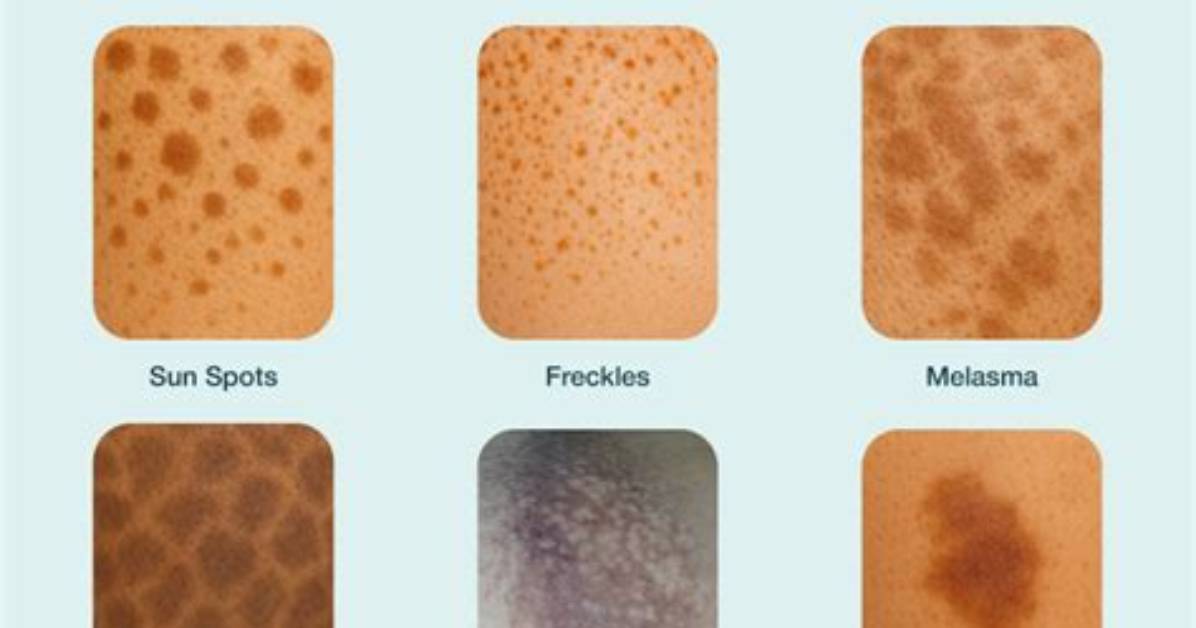 Do I Have Pigmentation?