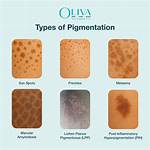 Do I Have Pigmentation?