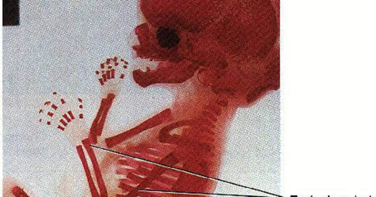 Do Intramembranous Bones Develop?