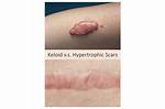 Do Keloids Have Pus?