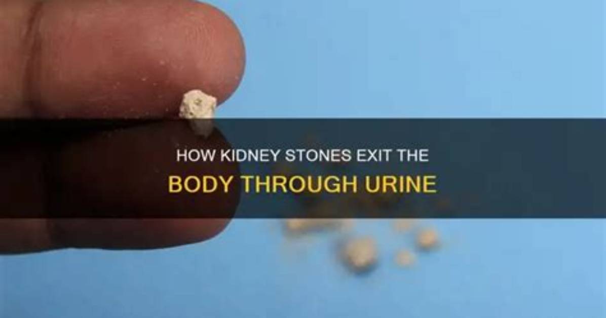 Do Kidney Stones Float When Passed?