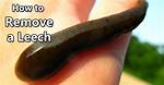 Do Leeches Hurt