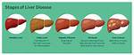 Do Liver Problems Cause Diarrhea?