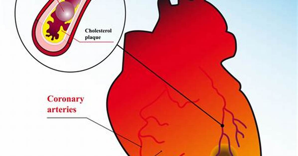 Do Massive Heart Attacks Hurt?