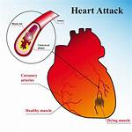 Do Massive Heart Attacks Hurt?