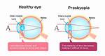 Do Myopia Develop Presbyopia?