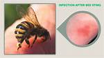 Do Native Bees Sting?