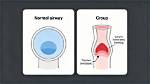 Do Nebs Help Croup?